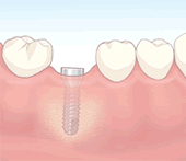 インプラント治療