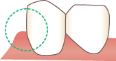 歯と歯肉の境目