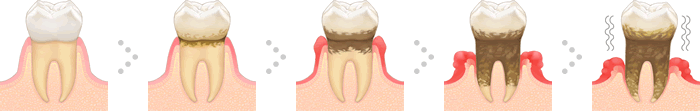 歯周病治療