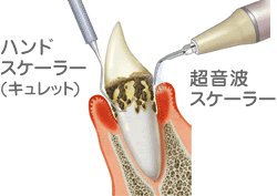 歯周病治療