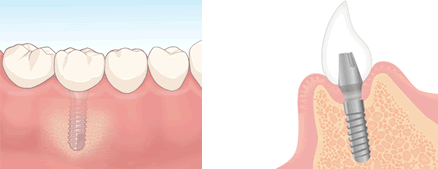 インプラント治療