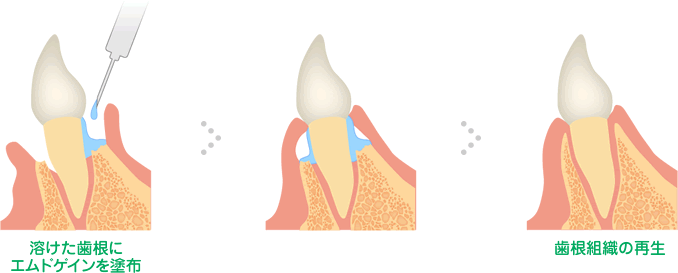 再生治療（エムドゲイン法）