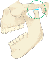 顎関節症